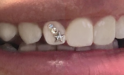 Tooth Gems, Tooth Gems in Miami, Swarvoski Crystal Tooth Gems